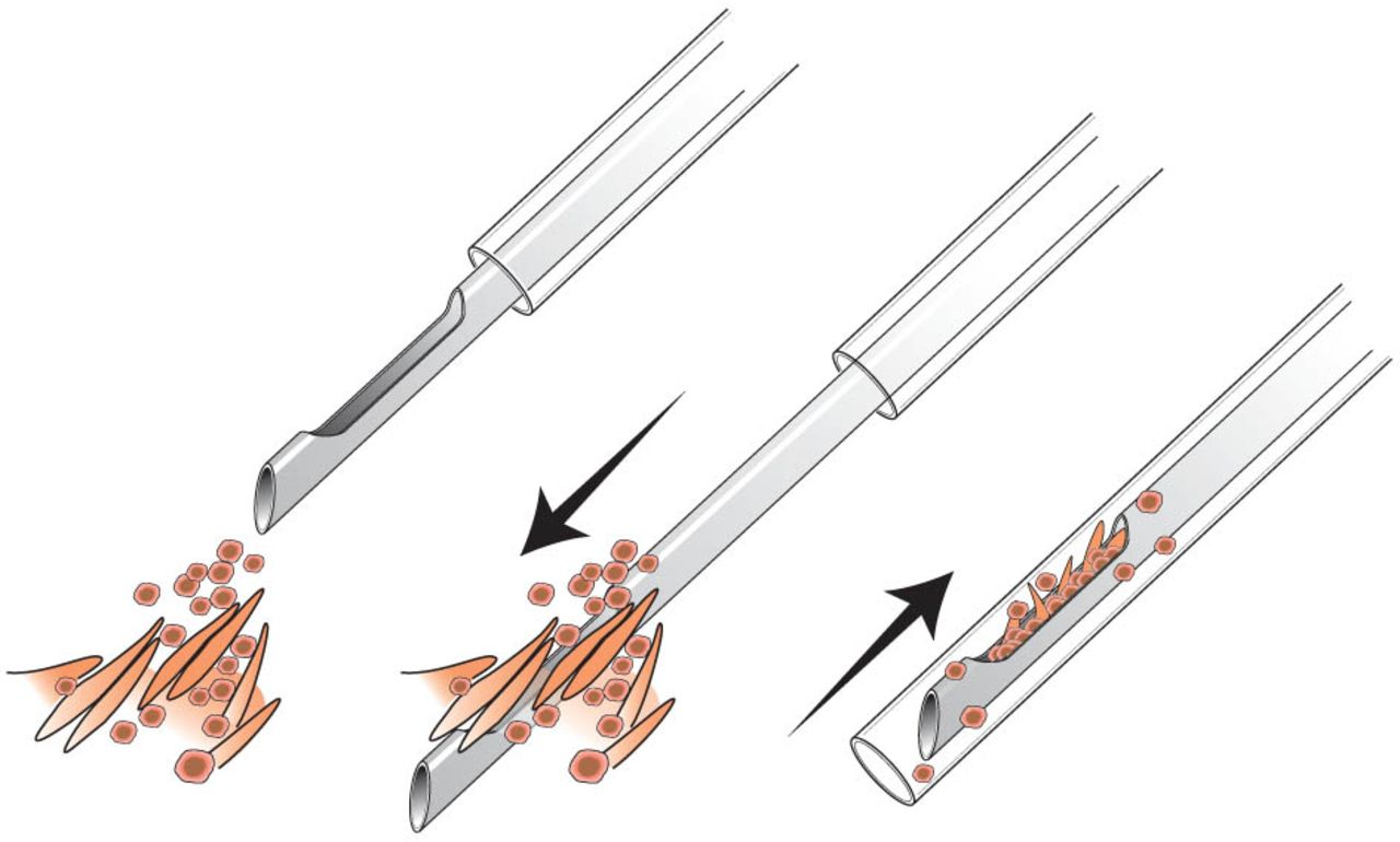 Толстоигольная биопсия при раке